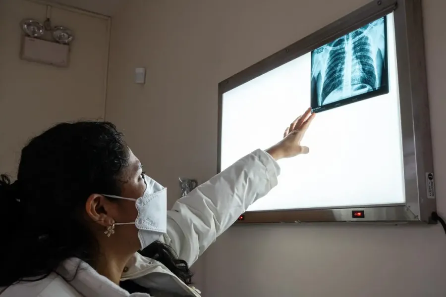 Landmark Clinical Trial Redefines MultidrugResistant Tuberculosis