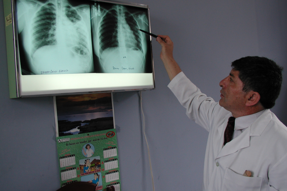 A doctor reviews a chest x-ray of a TB patient